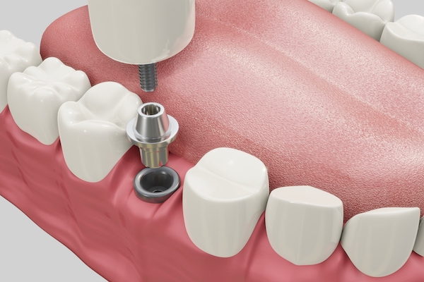 Implanty zębów Grójec